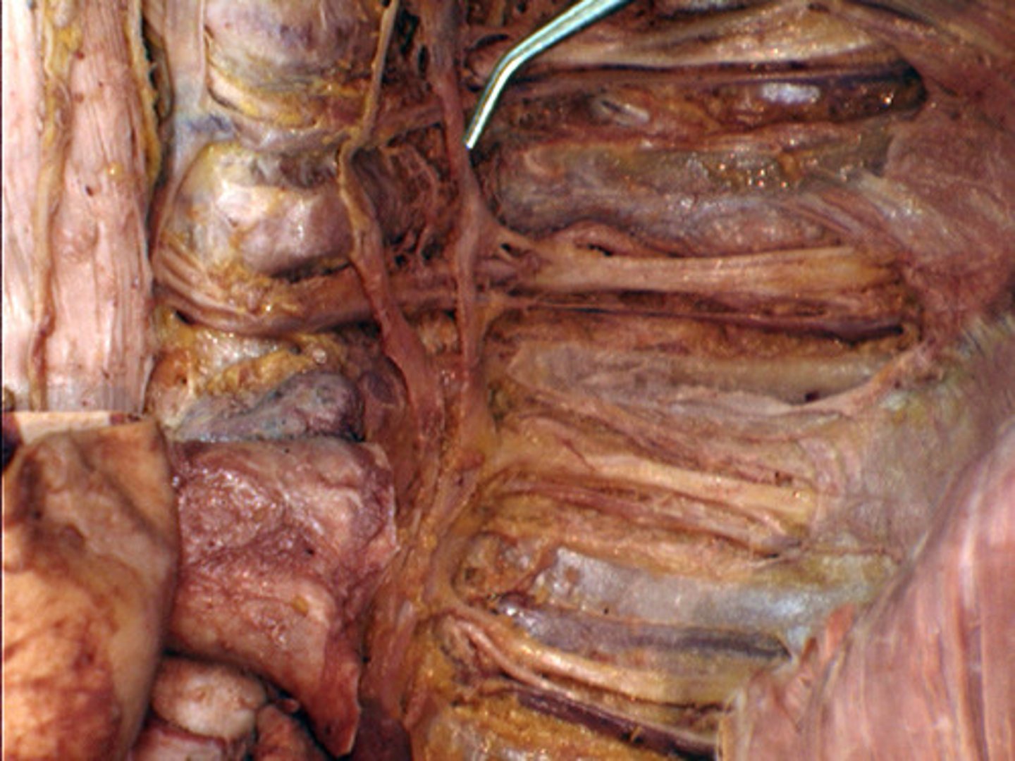 <p>-left side</p><p>-along vertebral column</p>