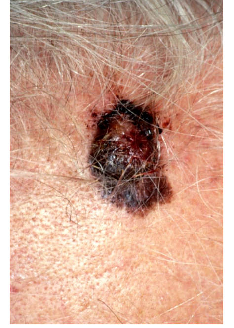 <ul><li><p>nodule</p></li><li><p>This patient has a nodular malignant melanoma on her forehead</p></li></ul><p></p>