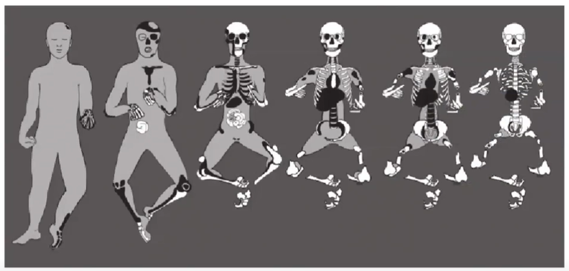 <p>Pugilistic pose caused by exposure to extreme heat</p>
