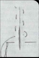 <p>Draws incision edges together; ligature exposed.</p>