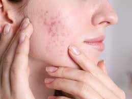 <p>acne</p>