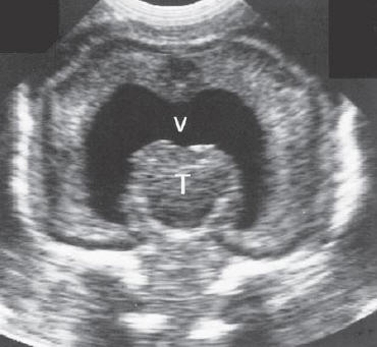 <p>Single ventricle</p><p>Fusion of thalamus</p>