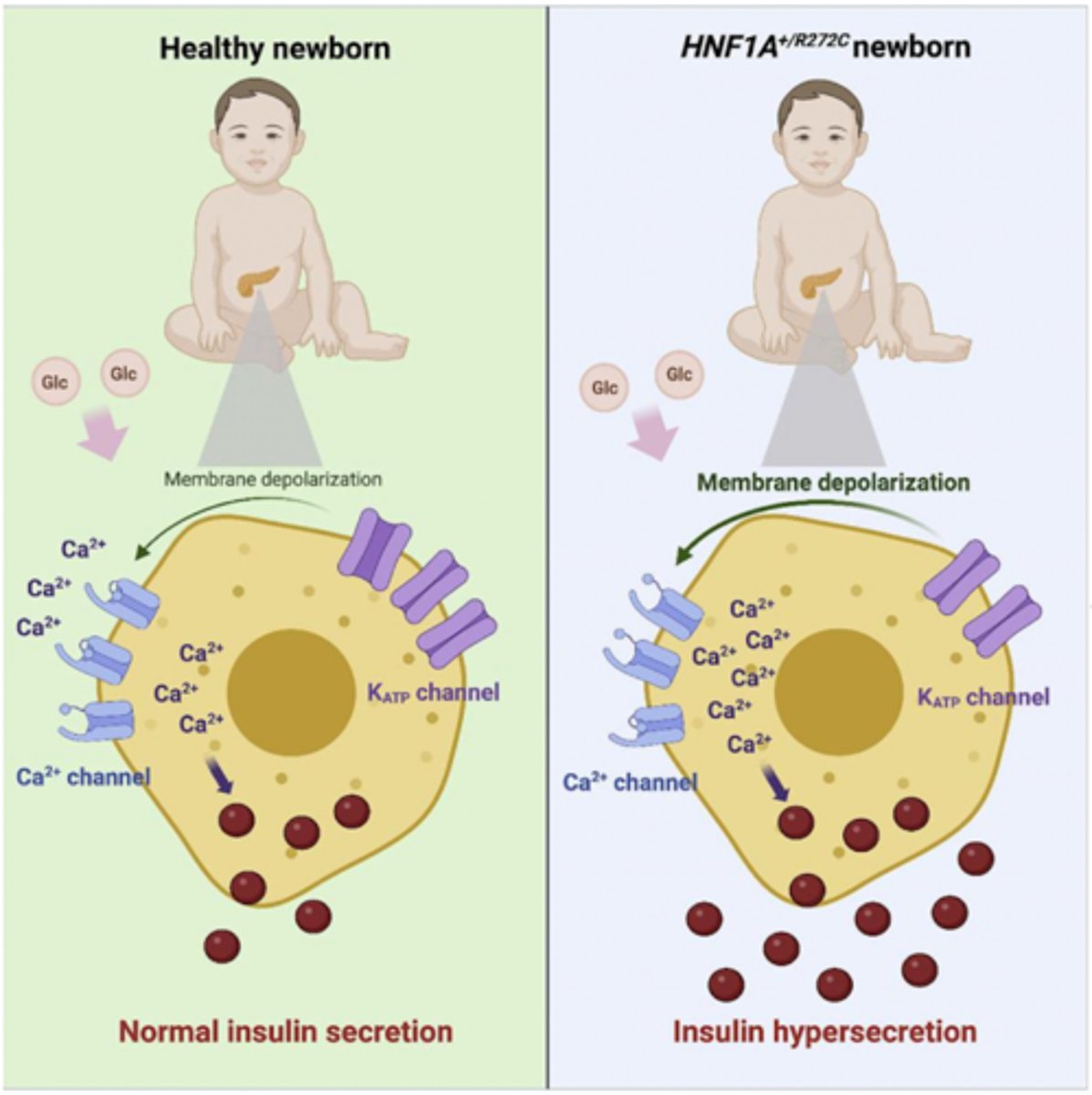 <p>o&nbsp;&nbsp; Rare, transitional hyperinsulinism in newborns due to decreased K+ ATP channel activity</p><p>o&nbsp;&nbsp; Decreased GLUT2 expression decreased glucose entry</p><p>o&nbsp;&nbsp; Decreased glycolytic gene expression  decreased ATP</p><p>o&nbsp;&nbsp; Impaired insulin biosynthesis and granule formation</p><p>o&nbsp;&nbsp; Progressive beta cell loss</p><p>o&nbsp;&nbsp; Long term: hyperglycemia</p>