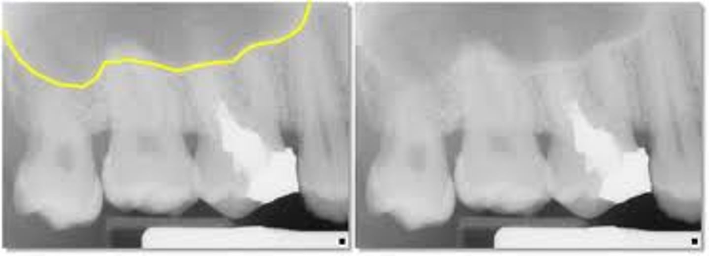 <p>lower border of the sinuses</p><p>radiopaque</p>