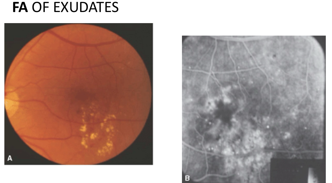 <p>FA: hypofluorescence (blockage) due to exudates themselves with areas of adjacent hyper fluorescence (<u>leakage</u>)</p><ul><li><p>aka exudates are dark, leakage is bright</p></li></ul><p>FAF: decrease in AF</p>