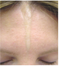 <p><span style="background-color: transparent; font-family: "Times New Roman", serif;">*Mild variant of systemic sclerosis</span></p><p><span style="background-color: transparent; font-family: "Times New Roman", serif;">*Affects only a solitary patch of skin</span></p><p><span style="background-color: transparent; font-family: "Times New Roman", serif;"><strong>*”En Coup de Sabre” – Strike of the Sword:</strong> resembles scars</span></p><p><span style="background-color: transparent; font-family: "Times New Roman", serif;">*Only a cosmetic concern, rarely life threatening</span></p>