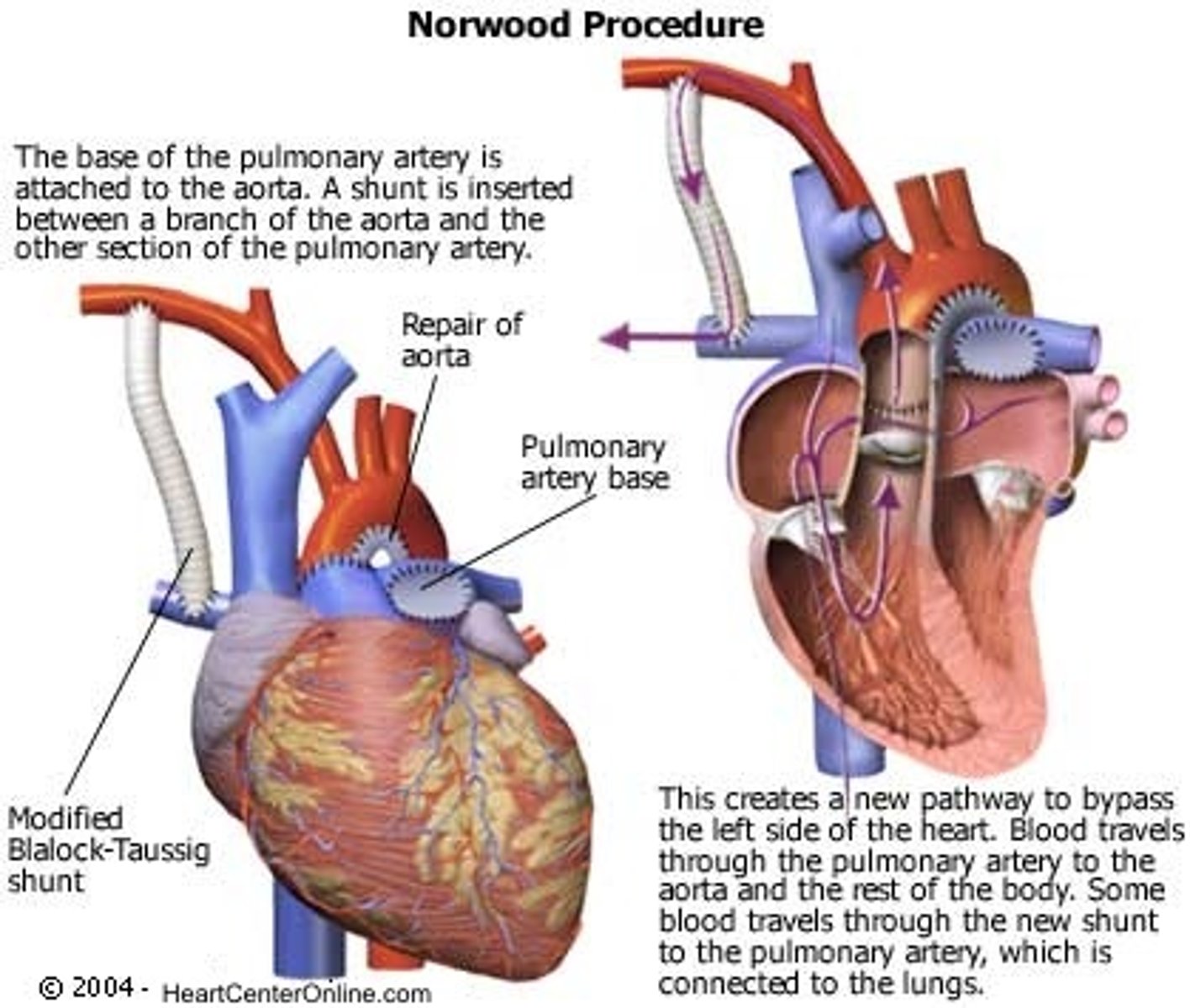 <p>STAGE 1</p><p>(Newborn — ASAP after birth)</p><p>• Goals: Provide systemic blood flow AND pulmonary blood flow using right ventricle</p><p>• Pulmonary artery (from RV) sewn to aorta → creates NEW aorta for systemic circulation</p><p>• Sano shunt added: RV → pulmonary artery tree → provides pulmonary blood flow</p><p>• ASD left OPEN — allows mixing (purple blood to both body and lungs)</p><p>• Result: One ventricle (RV) pumps to entire body AND lungs via shunt</p><p>• Baby remains as "Norwood-Sano baby" for ~4 months</p><p>• Why not Glenn/Fontan at birth? Pulmonary vascular resistance (PVR) too high — passive flow insufficient; must wait for PVR to drop</p>