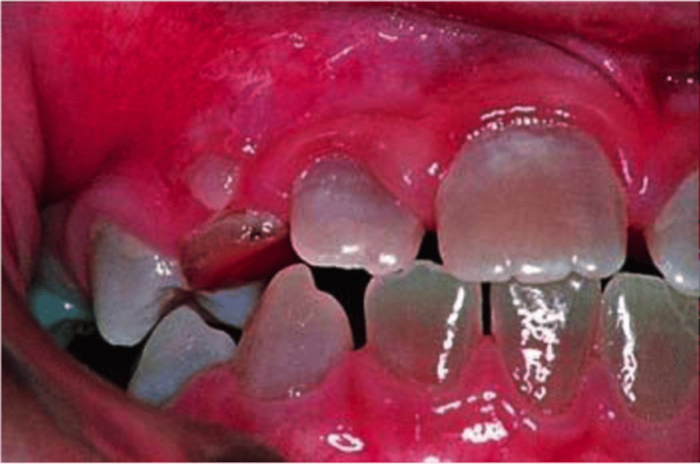 <p>dentogenisis imperfecta</p>
