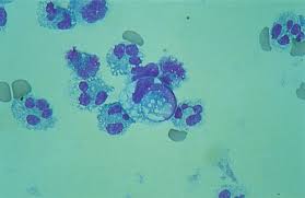 <p>vacuolated macrophages w/ ingested neutrophils, indicates autoimmine DZ</p>