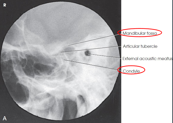 <ul><li><p>condyles and necks of the mandible</p></li><li><p>relationship between mandibular fossa and condyle</p></li><li><p>closed mouth: fractures of the neck and condyle of the ramus</p></li><li><p>open mouth: mandibular fossa and inferior and anterior excursion of the condyle</p></li><li><p>TMJ articulation</p></li><li><p>condyle lying in mandibular fossa in closed-mouth</p></li><li><p>condyyle lying inferior to articular tubercle in open-mouth</p></li></ul><p></p>