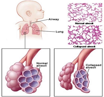 <p>-Under-aeration of the lungs caused by lack of surfactant</p><p>-affects premature babies who cannot produce enough surfactant to help keep lung sacs open</p>