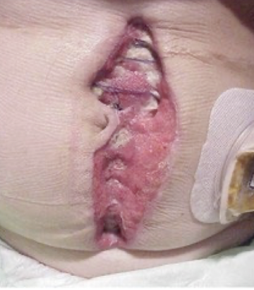 <p>rupture of wound, typically after abdominal surgery due to increased pressure</p>