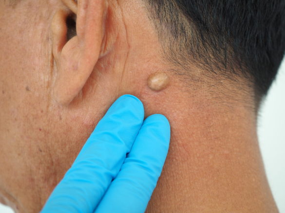 <ol><li><p>slow growing, round, moveable lump under skin </p></li><li><p>skin colored or yellowish hue </p></li><li><p>painless, unless inflamed or infected </p></li><li><p>small dark pit on surface (sometimes) </p></li></ol><p></p>