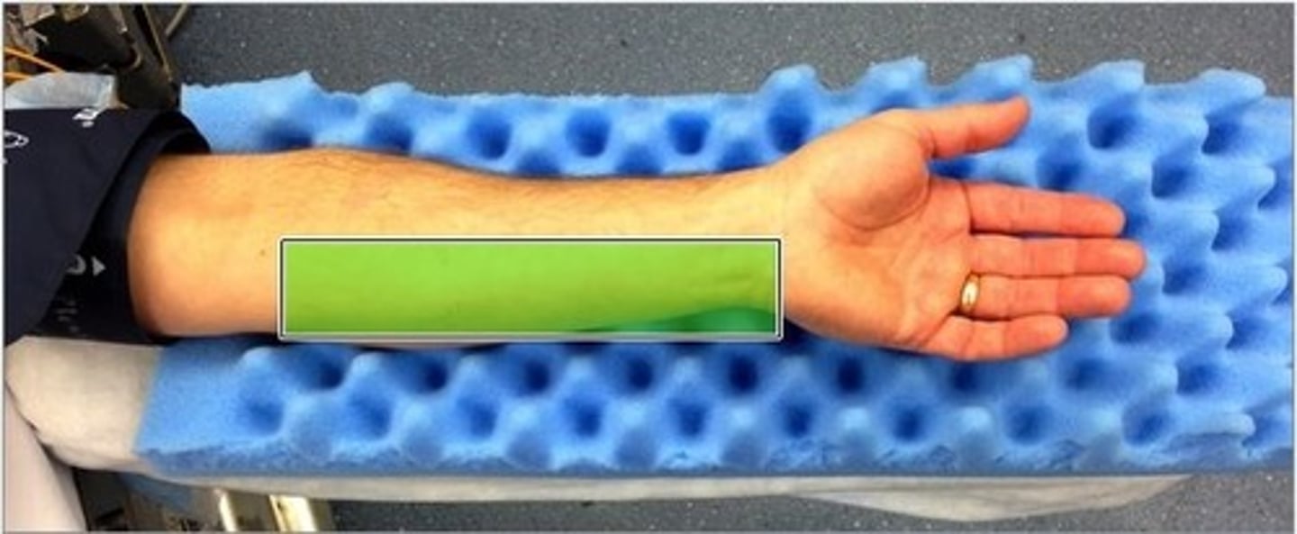 <p>Distal electrode is placed over the proximal flexor crease of the wrist and the proximal electrode is placed over the flexor carpi tendon.</p>