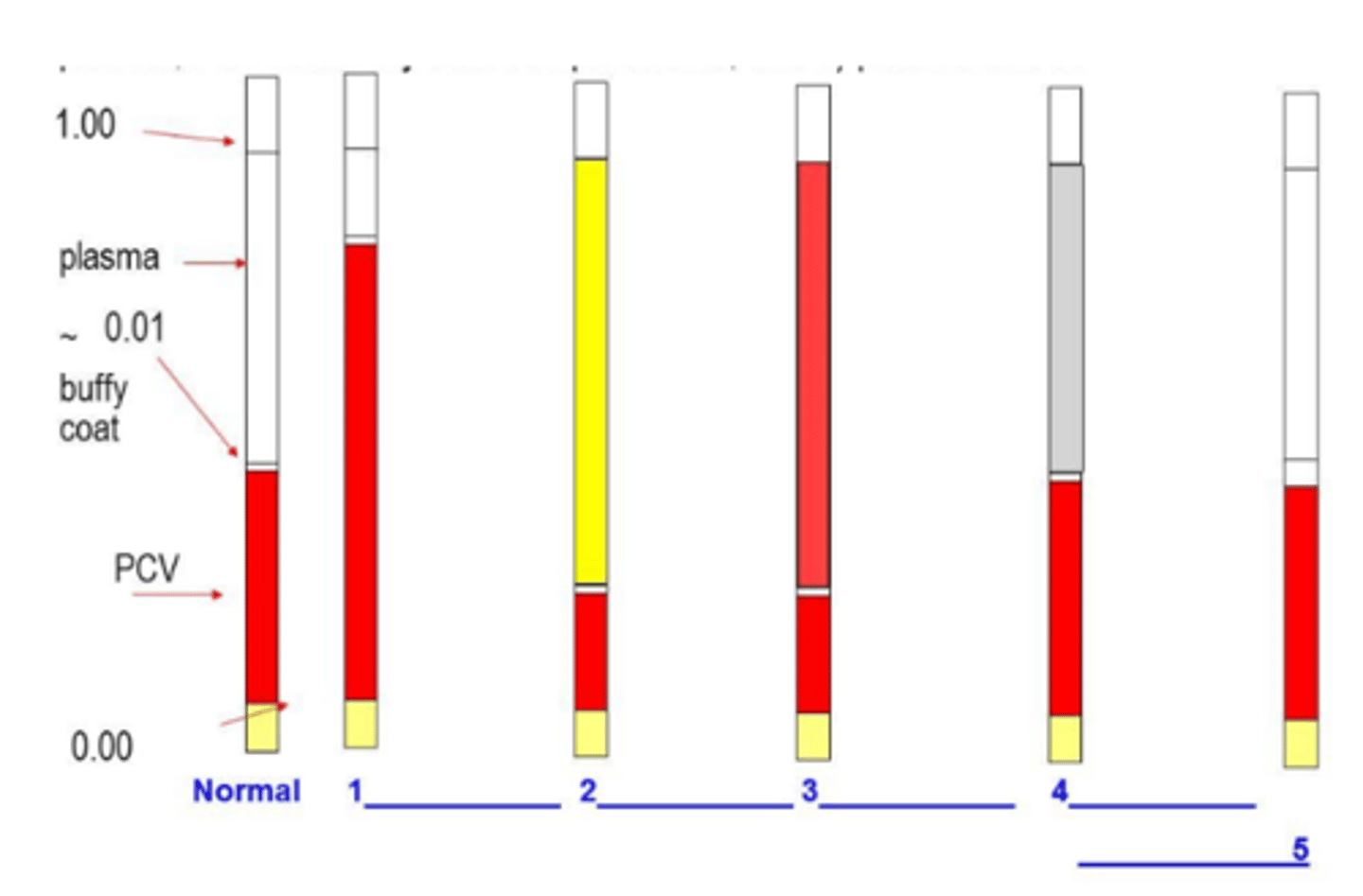 <p>Which of the microhematocrit tubes in plate 3 best indicates chronic, systemic inflammation?</p>