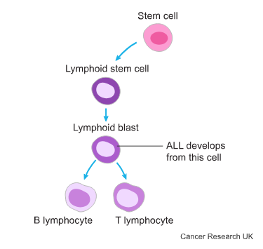 <p>Här sker monoklonal expansion av <strong>lymfoblaster</strong> (omogna celler) i ett tidigt mognadsstadie. För diagnos krävs mer än 20% lymfoblaster i benmärg → annars lymfom (SLL).</p><p>Det beror ofta på <strong>philadelphiakromosomen</strong> → en translokalisation av t(9;22) ger upphov till fusionsproteinet <strong>BCR-ABL</strong> som har tyrosinkinasaktivitet → ökad proliferering utan tillväxtfaktorer.</p><p>ALL leder till benmärgssvikt → andra cellinjer tryck bort vilket leder till trombocytopeni, anemier och lymfopeni (brist på friska lymfocyter).</p><p><img src="https://lh7-us.googleusercontent.com/vErFmMs2pDL_tAXPT84Ufg5BEMjoHuiiXTCaqo2QWrSHDawPT0HX8Unajj9QML1rbPBuDoDgKt0mTAkVO5Uy98DX-UhgNxCA2x1GPAJiDDghkti1uUtqVKgWLiVdnhYOXlT0bPIv_Pde_G3C6_gh_Ho" width="280" height="168"></p>