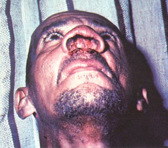 <p>Vector: Lutzomyia Cardinal Sign: infection around nose and mouth (?) Distribution: South America and Mexico</p>