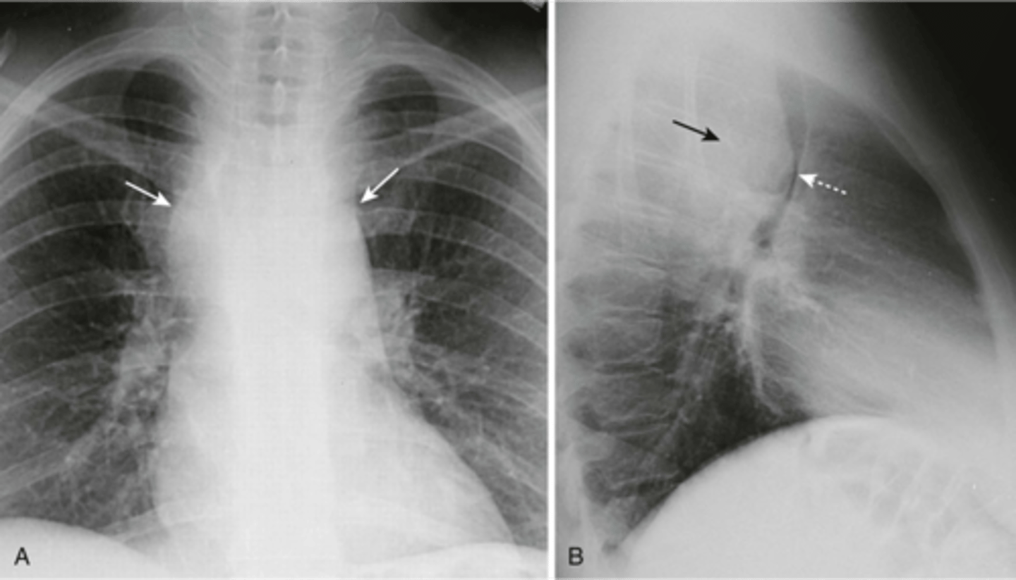 <p>lymphadenopathy can produce masses</p>