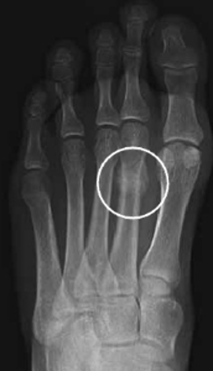 <p><strong>______________</strong> – stress fracture of 2nd, 3rd, or 4th MT</p><p>Seen in new recruits, athletes and dancers</p>