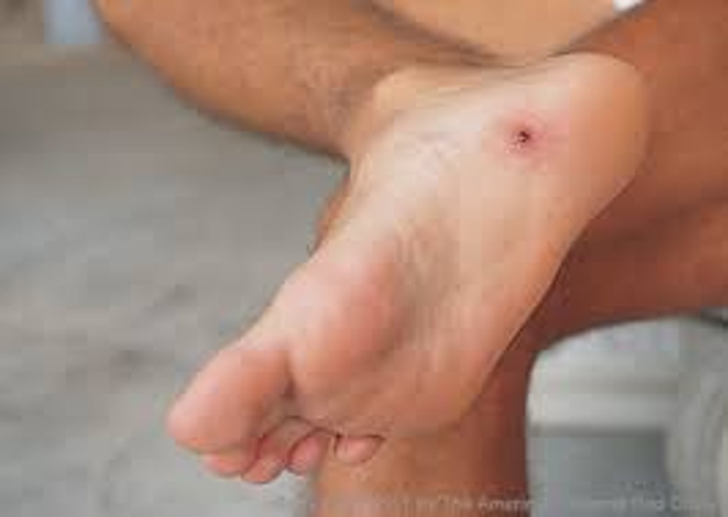 <p>When blunt or sharp object punctures the skin</p>