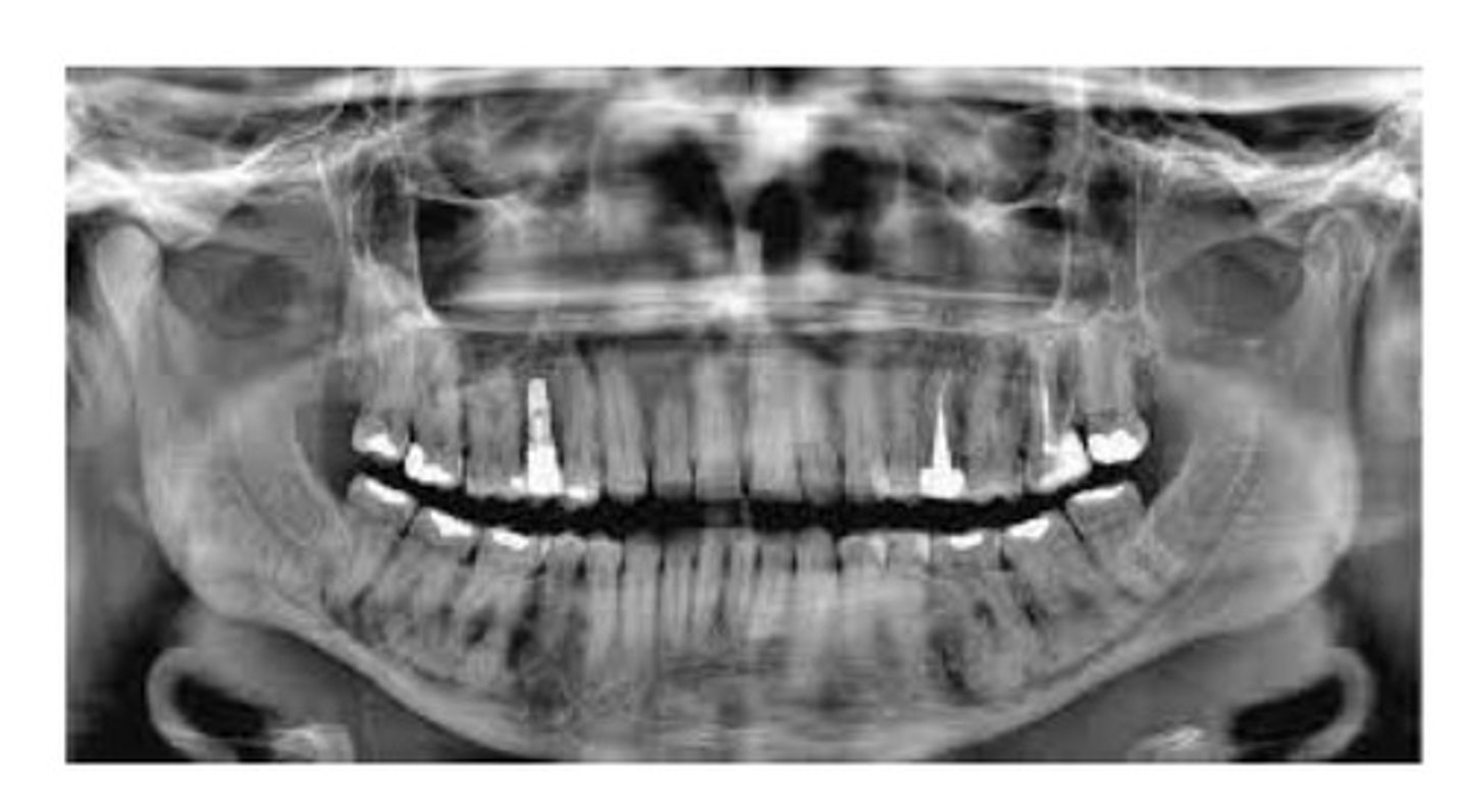 <p>A condition of disordered cementum and bone development. Best diagnosed on the basis of its characteristic patient history, clinical presentation, and Radiographic appearance. If asymptomatic, doesn't require treatment. Masses of irregular opacification are noted that are composed of dense sclerotic bone, cementum, or both.</p>