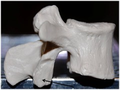 Name this specific part of the lumbar vertebrae.