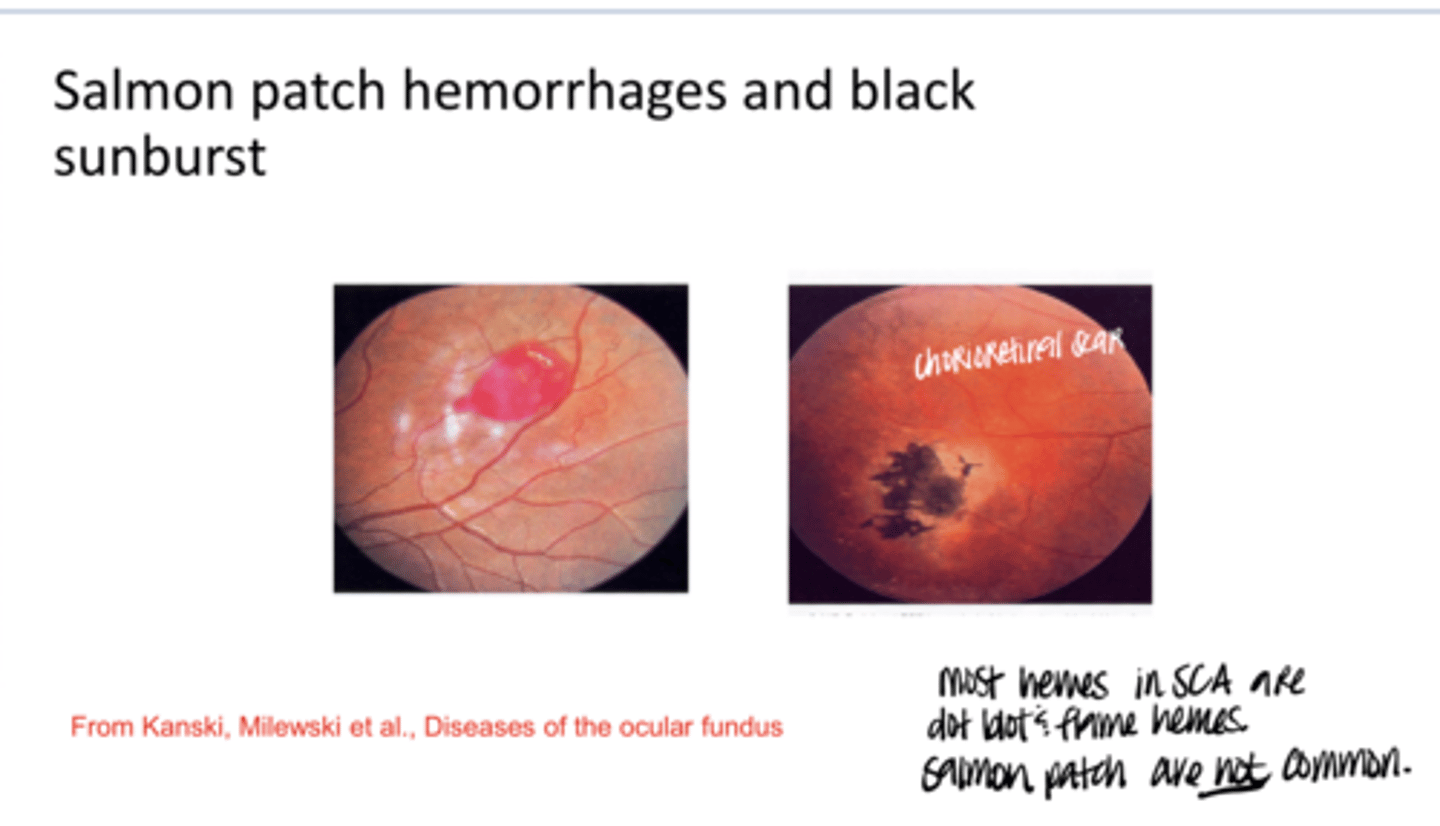 <p>Salmon Patch Hemorrhages and Black Sunburst (Pic)</p><p>**RBCs deoxygenated in salmon patch</p>