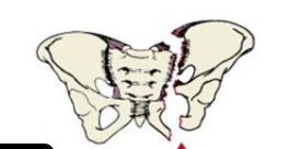 <p>Pelvic Fracture</p>