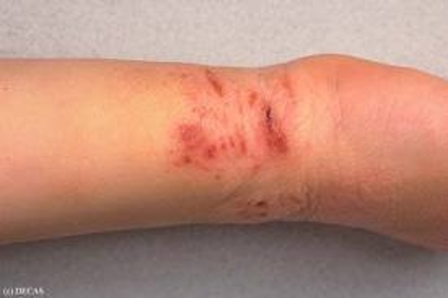 <p>secondary lesion; skin sore or abrasion produced by scratching or scraping</p>