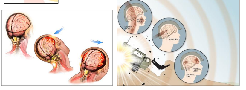 <p>Hoofdletsel na zware explosie</p><p>Repetitieve blast brain injuries in oorlogsgebieden → chronische traumatische encefalopathie (CTE)</p>