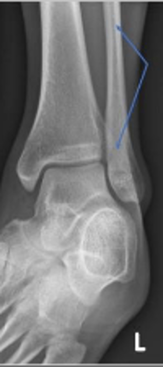 <p>What bone are the arrows pointing to?</p>