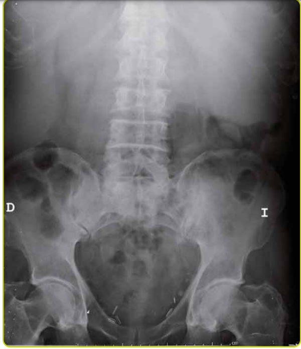 <ul><li><p>Síndrome constitucional </p></li><li><p>Hepato y esplenomegalia</p></li><li><p>Lesión osea esclerosadas en médula en proximales de huesos largos y esqueleto axial</p></li></ul>