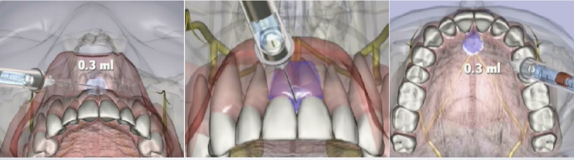 <p>labial frenum</p>