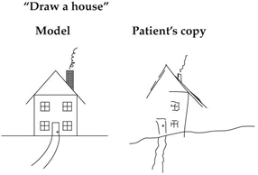 <p><span>A patient is asked to draw a house by copying the model picture shown above. His version is shown on the right. What disorder do you suspect the patient has?</span></p>