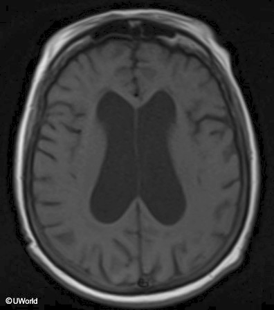 <p>difficulty taking steps, unsteady</p>