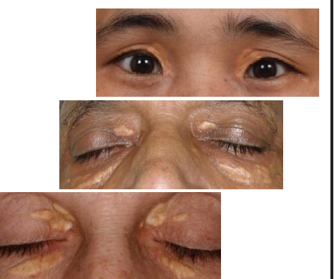 <ol><li><p>One or more flat, minimally elevated, <strong><u>creamyyellow</u></strong>, plaque-like lesions</p></li><li><p>• Often found <strong><u>medial aspect </u></strong>of eyelids</p></li><li><p><strong><u>• Often bilateral </u></strong>and symmetric</p></li></ol><p></p>