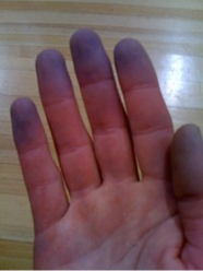 <p>abnormal condition of blueness or being blue</p>