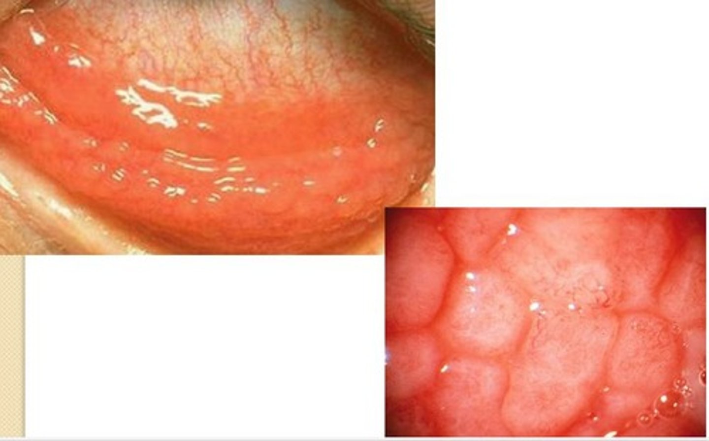 <p>Allergic conjunctivitis</p>