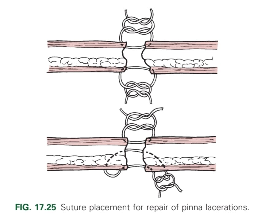<ol><li><p>Align cartilage and skin with simple interrupted sutures on both sides or a combination of simple interrupted and vertical mattress sutures.</p></li><li><p>Drainage at the outer edge of the wound</p></li><li><p>Cryotherapy to reduce oedema (first 48 hours of injury)</p></li></ol><p></p>