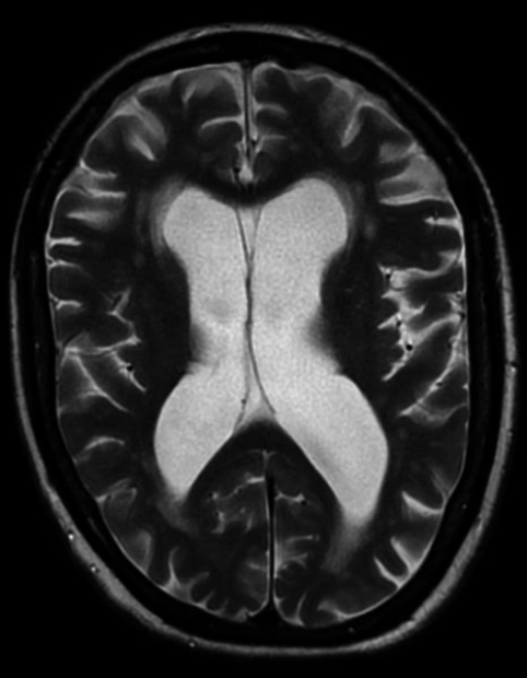 <p>White matter and infarcts </p>