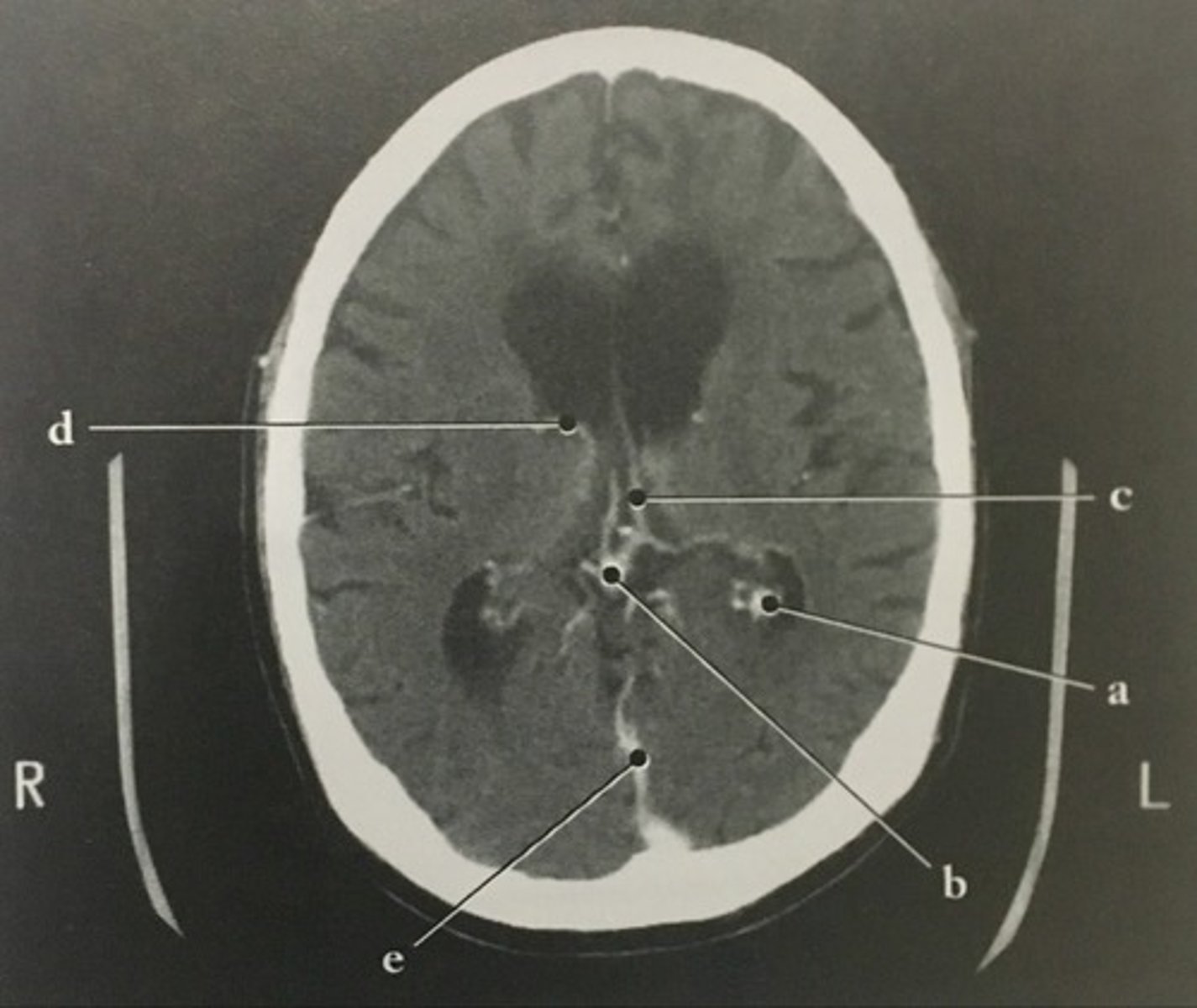 <p>Identify structure E on this axial CT slice of the brain.</p>