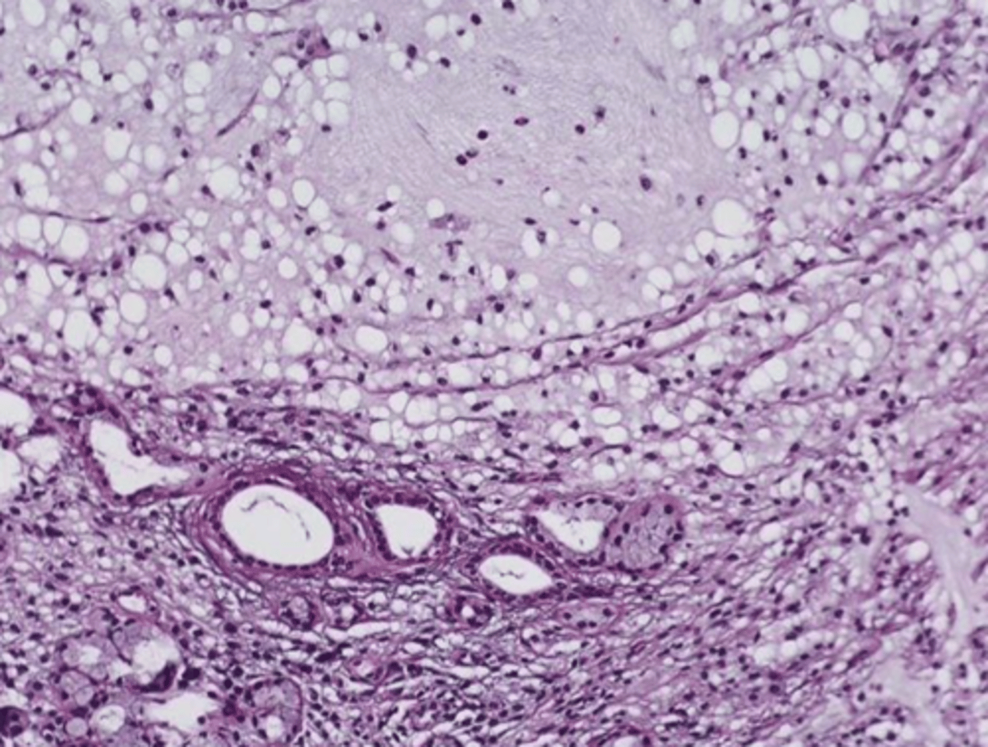 <p>• Granulation tissue</p><p>• Spilled mucin</p><p>• Inflamed salivary gland tissue</p>