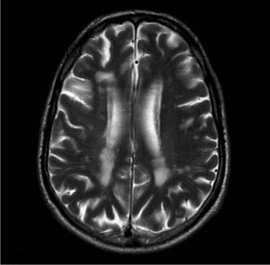 <p>small subcortical lucencies / <strong>lacunar infarcts</strong></p>