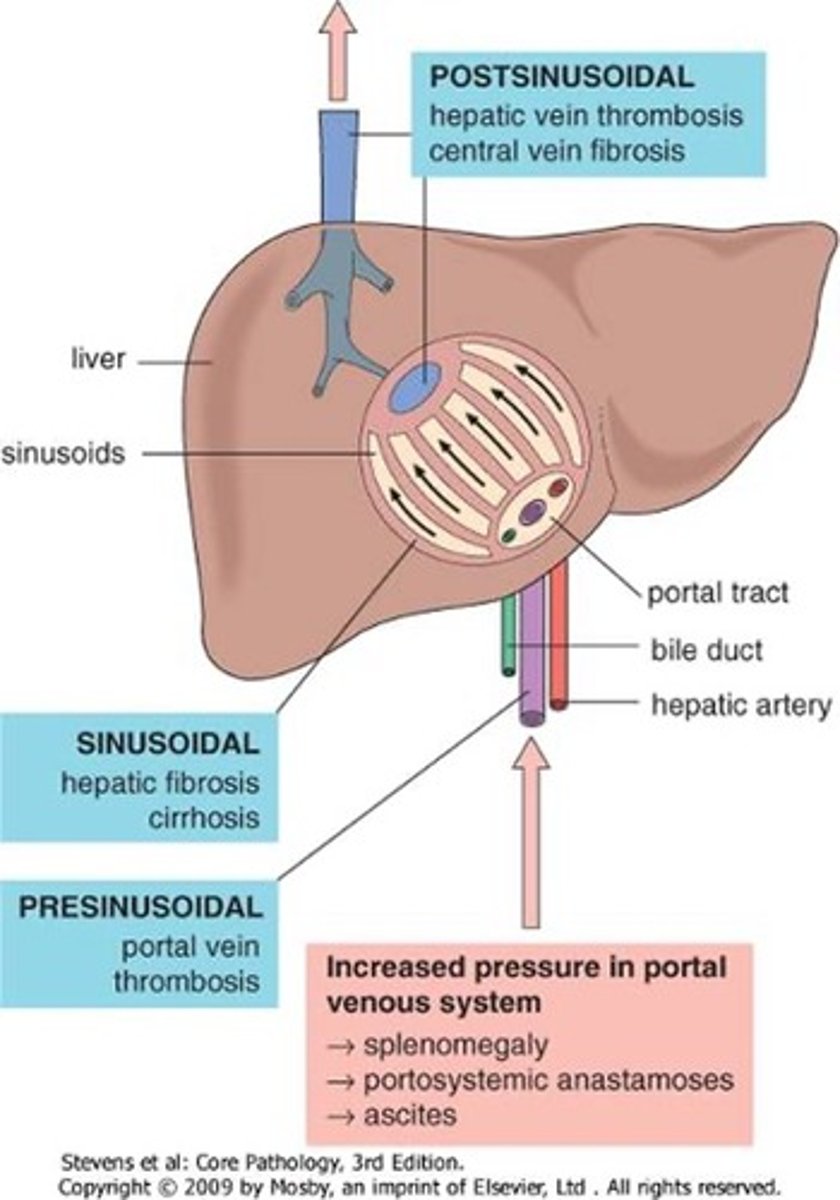 <p>1. Sinusoid destruction so portal vv blood can't escape &gt; increased Pa.</p><p>2. Only escape is via anastamoses with systemic venous system, which open under high Pa &gt; distention &gt; varices.</p><p>3. Happening at lower end of oesophagus can bulge into lumen and be eroded by gastric acid &gt; torrential haemorrhage (fatal). </p>