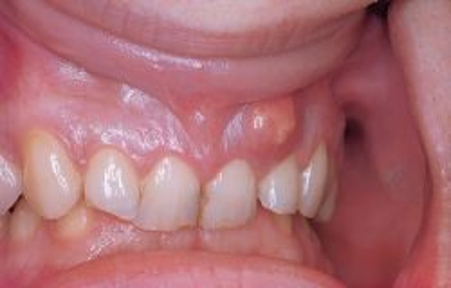 <p>inflammation of dental pulp</p><p>pre existing periapical chronic inflammation</p>