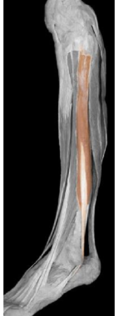 <p>Fibularis (peroneus) longus</p>