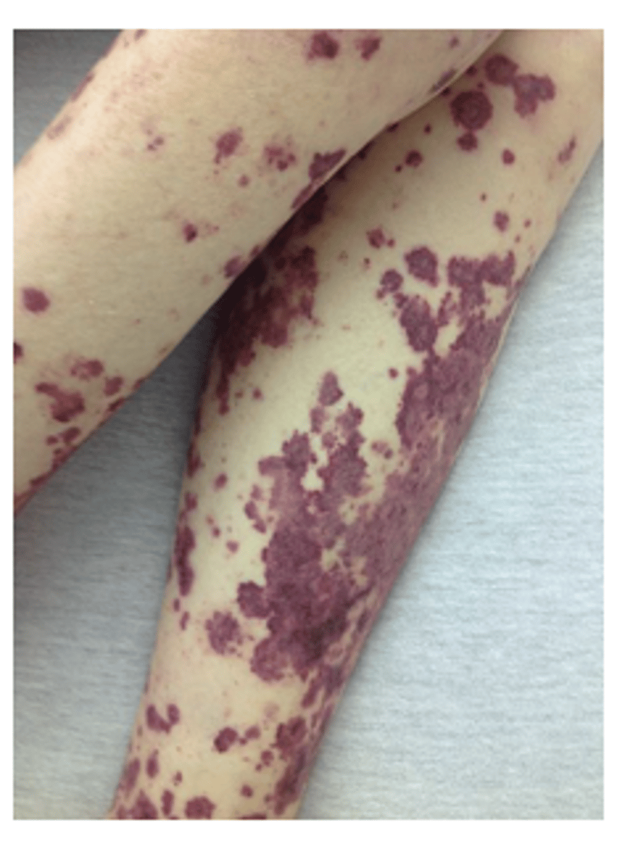 <p>A 9-year-old girl with autism comes to the hospital with severe bone pain that keeps her from walking for 2 months. She also has a petechial rash and gingival swelling. An orthopedic workup, including extremity and back MRI, is negative. When asked specifically, her mother reports that her diet consists of frozen pancakes and chocolate milk. Which of the following deficiencies is most likely the cause of her symptoms?</p><p>a.Folate</p><p>b.Iron</p><p>c.Vitamin A</p><p>d.Vitamin C</p><p>e.Vitamin D</p>