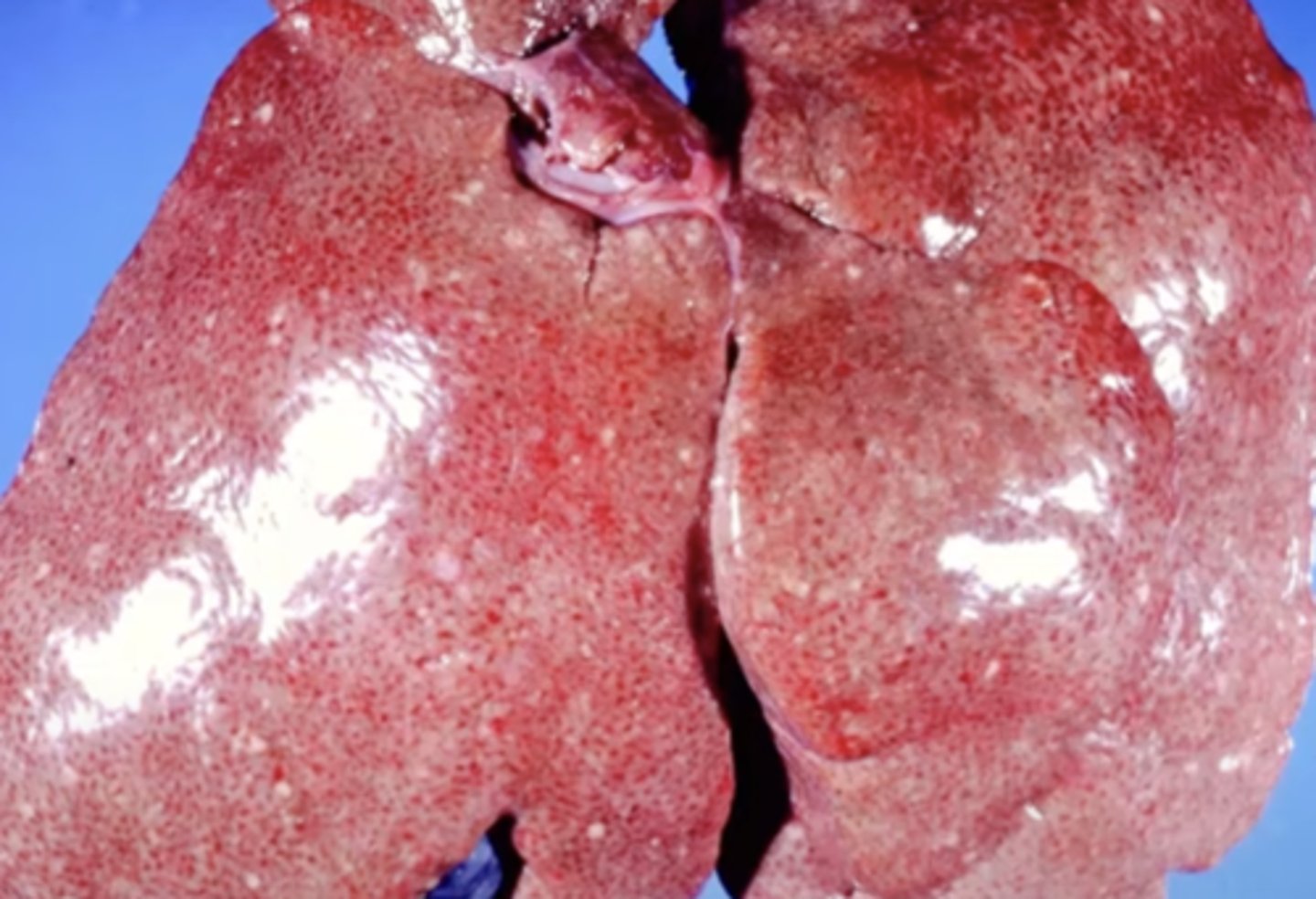 <p>What has caused this gross appearance of this liver?</p>