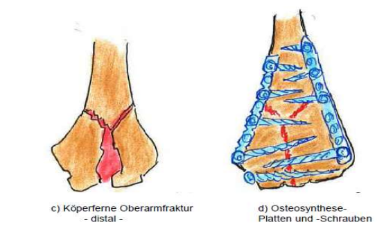 <p>Distale Oberarmfraktur - kompliziert</p><ul><li><p>viele Schrauben notwendig</p></li><li><p>Doppelplattensynthese</p></li></ul><p></p>