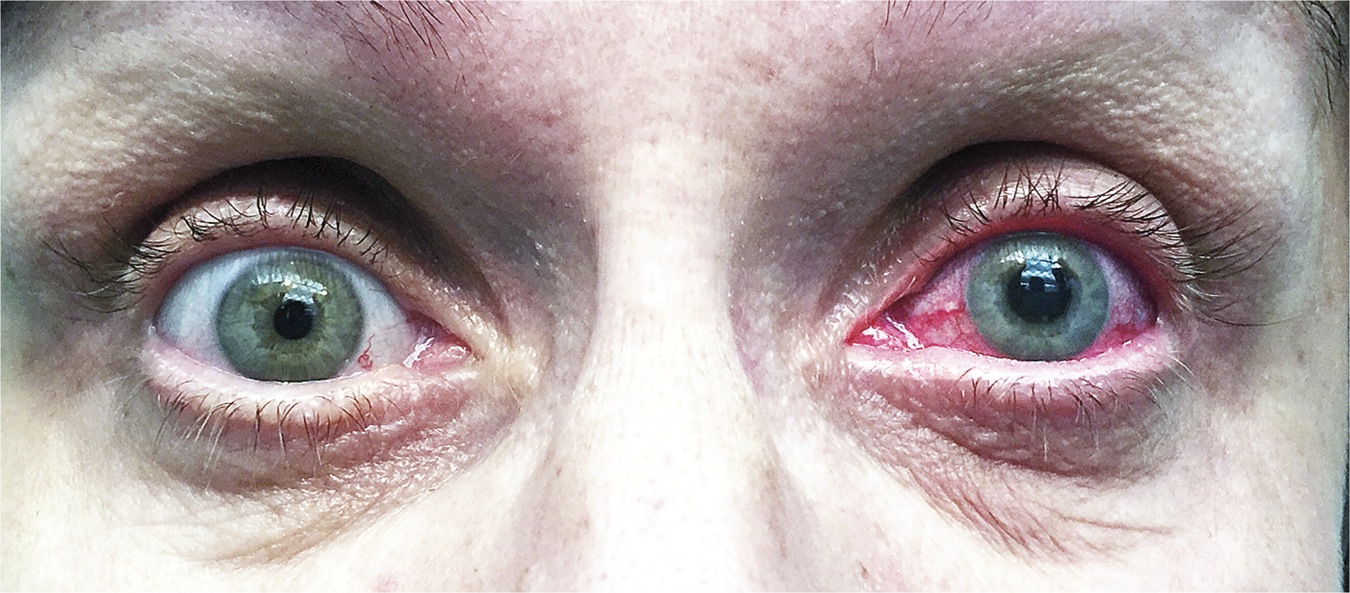 <p>PP/E: iris blocks exit of aqueous humor from anterior chamber→acute/dramatic elevation of intraocular pressure→nerve cell/neuron death</p><p>CM: <strong>intense ocular pain</strong><br>blurred vision<br>halos around lights<br>±N/V</p><p>PE: diffuse conjunctival injection<br>fixed+dilated pupil<br>cloudy cornea<br>optic cup enlargement (glaucomatous cupping)</p>